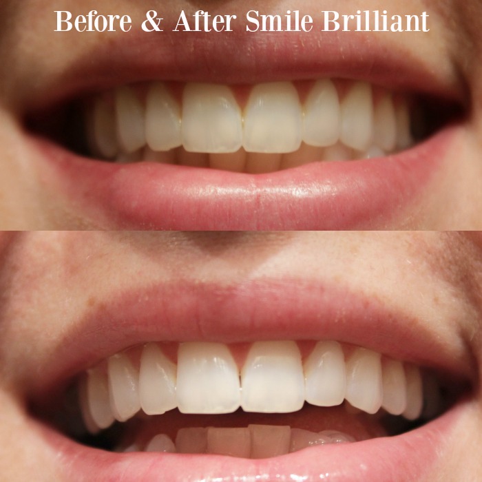 smile brilliant before & after #ad